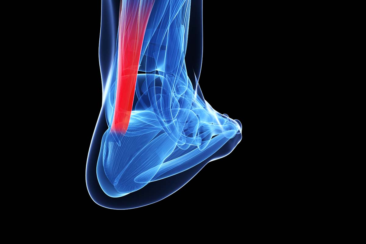 Achilles Tendonitis