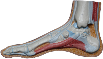 Plantar Fasciitis